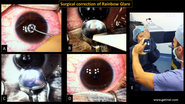 Surgical correction of rainbow glare