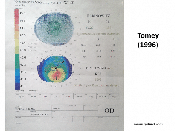 Example of the verdict of the automated keratoconus screening system used in 1996 on the TMS-2 topographer (Tomey): the appearance of the colourimetric map strongly suggests the presence of early but true keratoconus. The verdict of Rabinowitz and Klyce/Maeda automated indices is that of keratoconus-suspect. 