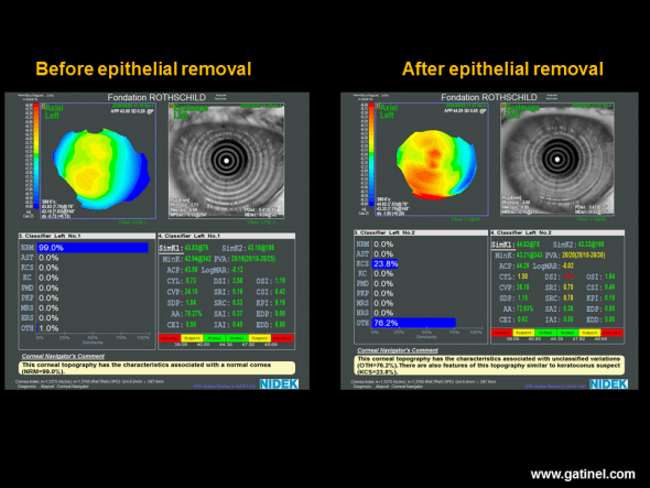 Axial Placido topography performed before (left) and after (right) removal of the corneal epithelium during a surface photoablation procedure (photorefractive keratectomy: PRK). Before photoablation, the inferior paracentral curvature is slightly increased. Neural network analysis suggests a normal anterior corneal surface, and the (I-S) value, calculated manually, is estimated at 0.6 D. After careful, atraumatic removal of the corneal epithelium, good quality reflection of Placido rings is obtained by Bowman’s membrane, which presents a good quality lacrimal film, allowing calculation of the axial curvature map of the superficial stromal layer (Bowman/air interface). Bowman’s membrane presents a globally steeper and more irregular appearance and increased values of CYL, DSI, SRI and SRC indices. Neural network analysis suggests the possibility of subclinical keratoconus-suspect. This is not an isolated case and suggests that the corneal epithelium tends to mask toricity, irregularity and asymmetry present in the superficial stromal layer of Bowman’s membrane. This type of modification is impossible on the posterior surface of the cornea, which is devoid of stratified epithelium. This action of the epithelium is suggested more indirectly by the poorer correlation observed in corneas with keratoconus-suspect between the anterior and posterior values of certain parameters (asphericity, toricity), compared to those observed in healthy corneas. 