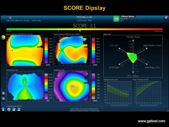 SCORE software display: the map uses the classical Orbscan Quad Map display. The value of the SCORE corresponds to calculation of a discriminant function established from 12 indices. The optimal cut-off value is zero. In this example, the calculated score of 2.1 suggests the presence of subclinical keratoconus. This map (left eye) was obtained in a patient with advanced keratoconus of the right eye. Despite negative screening based on Placido topography alone (OPD Scan III, Klyce/Maeda indices, Corneal Navigator software), the score was strongly positive. Calculation of the score is based on 12 Placido topography, elevation and pachymetry indices. 