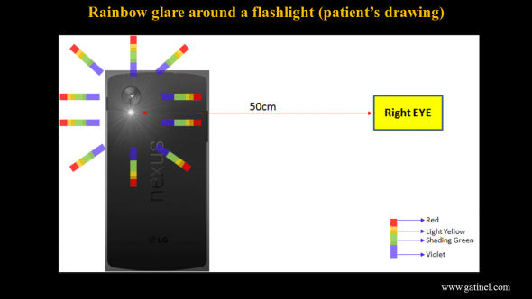 Patient’s representation of its rainbow glare when looking at a bright light source (smartphone flashlamp). 