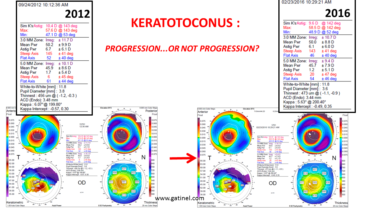 Keratoconus progression Docteur Damien Gatinel