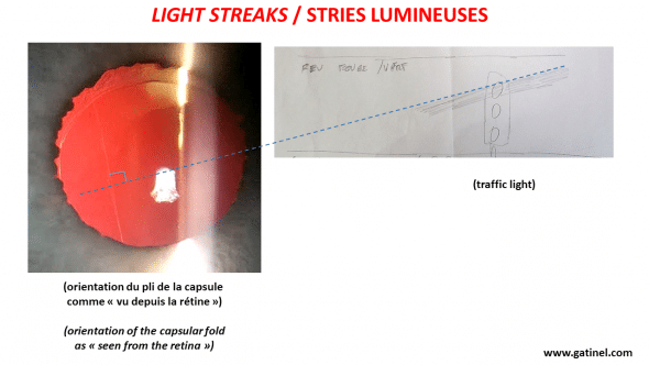capsular fold after cataract surgery has a perpendicular direction to the perceived light phenomena