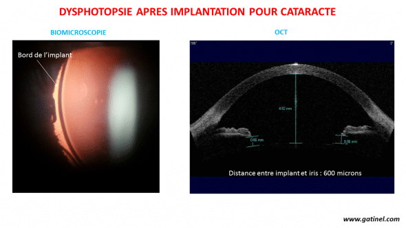 dysphotopsies et OCT