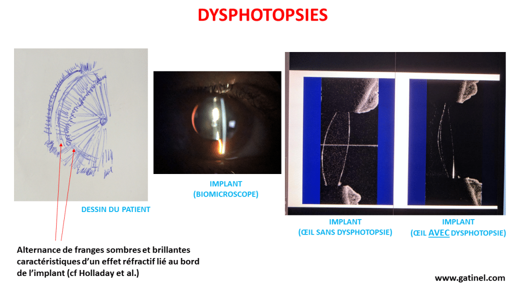 Dysphotopsies perçues par un patient au niveau de l'oeil droit, alors que les deux yeux ont été opérés de la cataracte. La localisation des franges lumineuses dans le champ visuel correspond à la réfraction par la cornée de rayons lumineux périphériques, entre l'iris et le sac capsulaire.