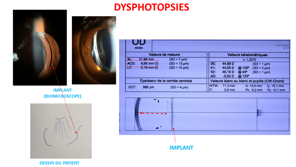 dysphotopsies