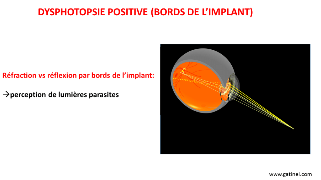 Dans certaines circonstances et configurations liées au diamètre de la pupille et la position relative du bord de l'implant, certains rayons lumineux peuvent être réfléchis par le bord de l'implant. Ceci peut occasionner la perception de scintillements lumineux.