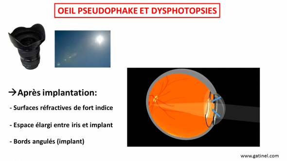 oeil pseudophake