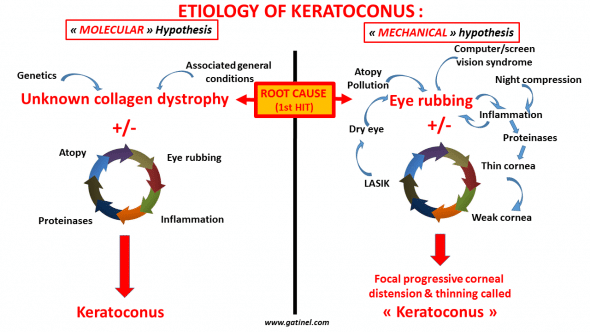 keratoconus cause