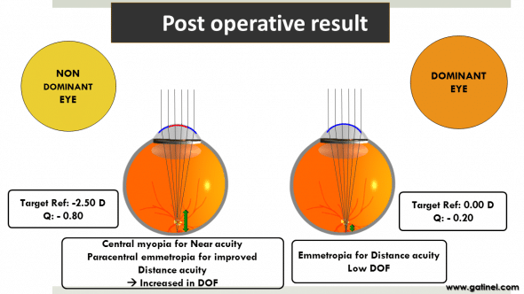 Figure 8c : Schematic representation of the expected postoperative result 