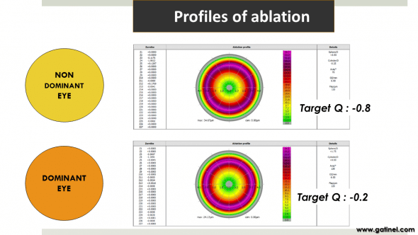 Figure 8d : Representation of the ablation profiles for the dominant vs non-dominant eye. Targeting a more prolate cornea causes the reduction of the peripheral depth of ablation. 