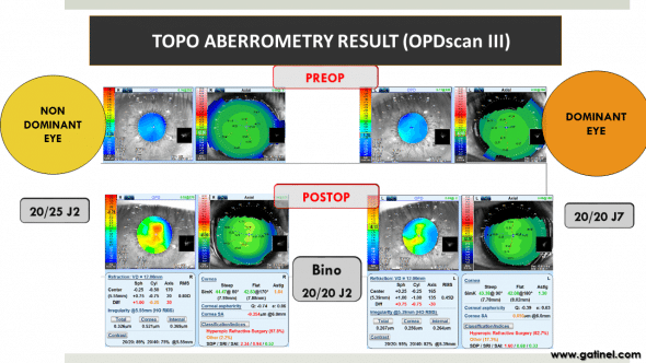 Figure 8e : Topographic and aberrometric comparison between the preoperative and postoperative data. Notice the « myopic island » on the postoperative OPD map of the non domiant eye (left) 