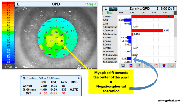 nuclear cataract opd map multifocality