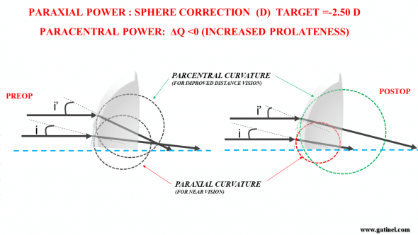 Figure 6 b : The combined correction of presbyopia and hyperopia can be schematically depicted as the change of paraxial curvature to a value (shorter radius) which induces a postoperative myopic refraction (ex: -2.50 D). Paracentral curvarture can be adjusted by selecting a specific target asphericity. This asphericity change aims at reducing the paracentral curvature, so that the refractive power of the paracentral zone is close to emmetropia. 