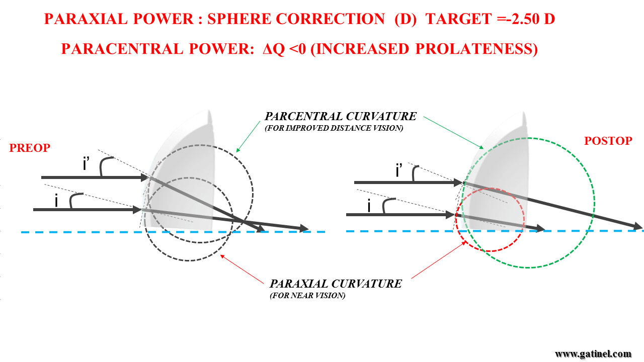 presbyopia korral összefüggő hyperopia