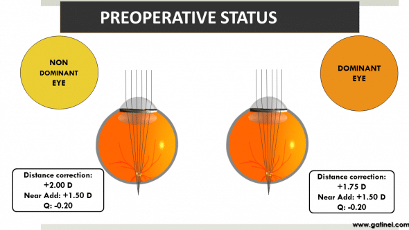 hyperopia and presbyopia