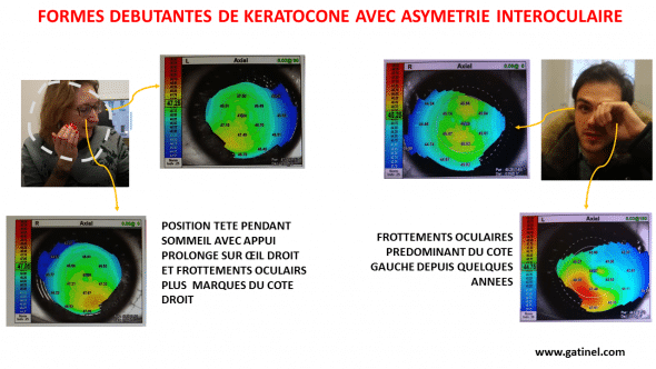 Les frottements oculaires concernent souvent un côté plus que l'autre. De nombreuses formes dites unilatérales surviennent du côté où la tête est appuyée pendant le sommeil, contre l'oreiller (ici représenté en pointillés, la patiente mimant sa position de sommeil).