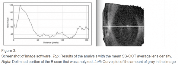 OCT scan images of crystalline lens