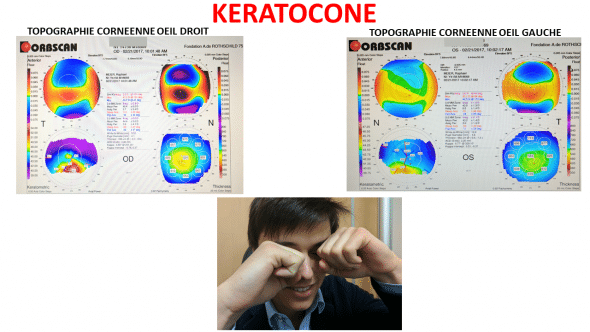 topographie cornéenne et frottements oculaires a l origine du kératocône.