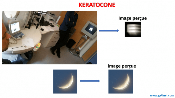 symptômes visuels du kératocône