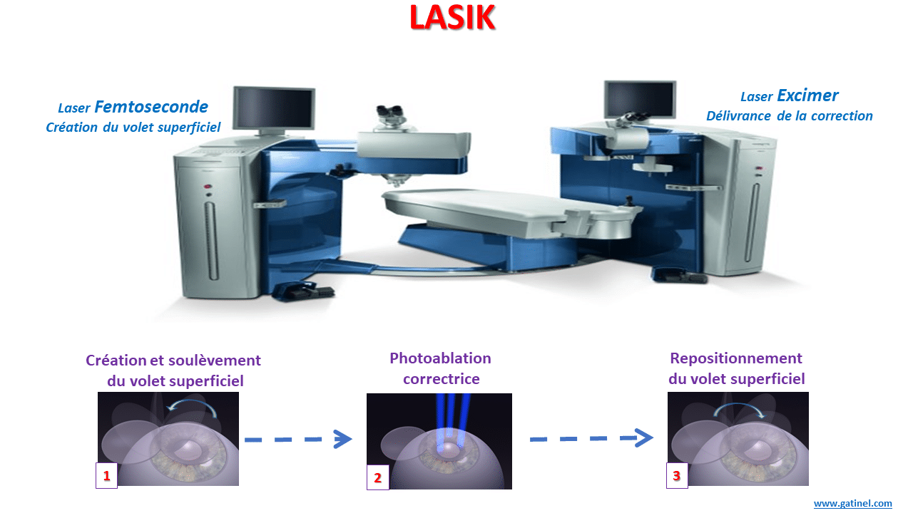Le principe du laser