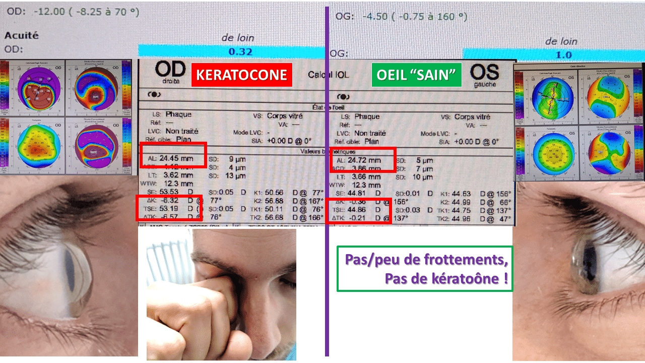 inflamarea pleoapelor superioare cauze deteriorarea vederii și primul ajutor