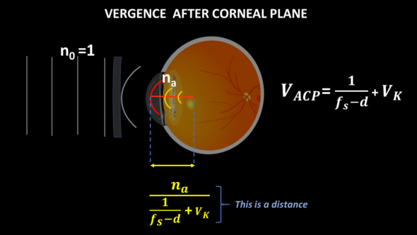 vergence after corneal plane
