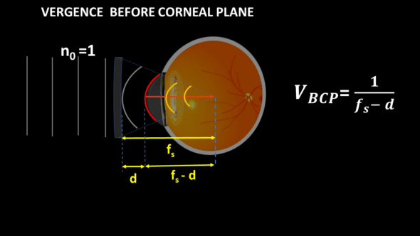 vergence before corneal plane