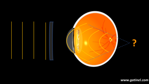 vergence after pseudophakic eye