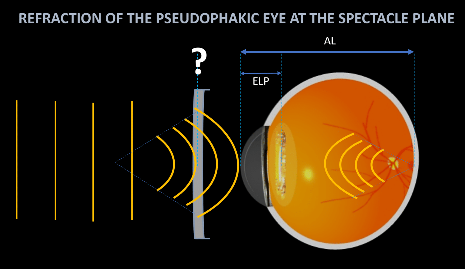 12. Refraction of the pseudophakic eye Docteur Damien Gatinel
