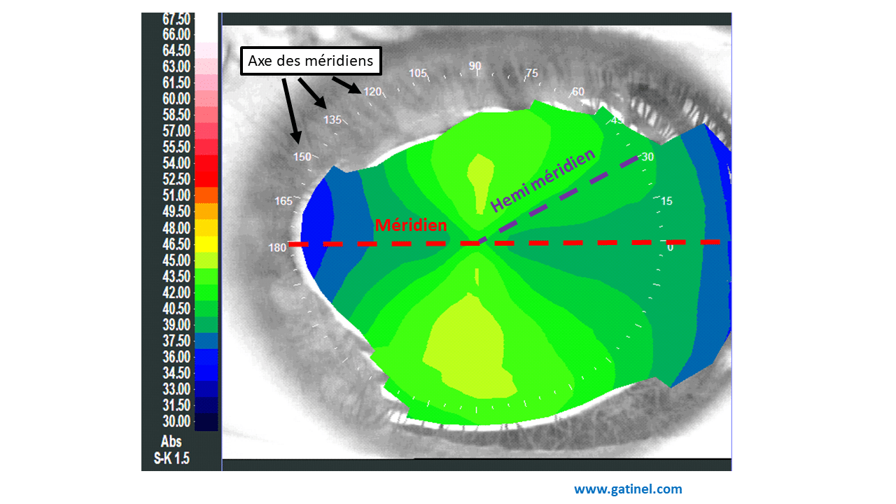 Corriger sa vue : lunettes / lentilles / chirurgie… que choisir ?