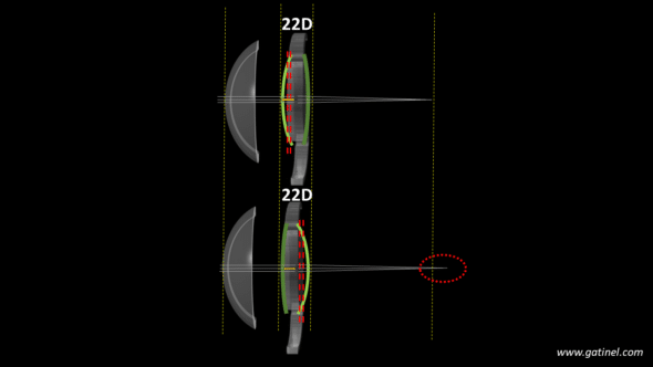 impact of IOL design on Effective lens position and subsequent refraction of the pseudophakic eye